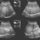 liver parenchymal calcification 이미지