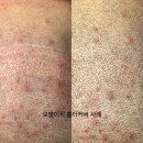 인천 두피문신, 헤어라인문신 전문 그레이시티에서 완벽한 변화