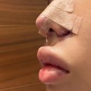 유주왕외과의원 | 무보형물코성향 비개방코성형 👃🏻 더타이트 씬코 후기 (가격/붓기/통증/꿀팁) 1~7일차 리얼후기 내돈내산