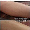 종아리 모공각화증, 인그로운헤어 라비앙로즈에스테틱 알라딘필링 개선 후기