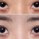 올바른남성의원 | 한쪽 쌍꺼풀 풀림 현상의 해부학적 원인과 올바른 재수술 접근법