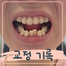 강서치과 | 강서구교정치과 화곡역치아교정 4개월차 장단점 솔직후기