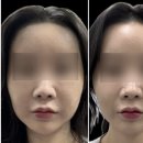 [약손명가 청담골드스타점] 여드름대마왕 경락 내돈내산 후기