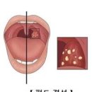 편도결석 증상 제거 예방 방법 자세히 알아봐요 이미지