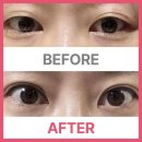 30대 중반 짝눈의 쌍커풀 매몰 수술 후기