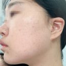 한비뇨기과의원 | 내돈내산 선릉 힐비뇨기과의원 잡티제거 한달 후기, 가격, 관리방법