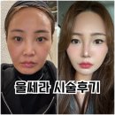 새생명약국 | 청담피부과 울쎄라 리프팅 내돈내산 시술 후기