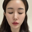 이브2 | 강남 피부과 추천 중안부 고민 해결 이브타이탄 피팅 레이저 2주 솔직 후기