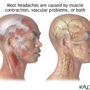 두통(headaches) 이미지