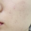 이나영피부과의원 | 안산 피부과 여드름흉터 포텐자 레이저 솔직 후기 + 사진 첨부