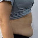 예스의원 | 세이예스의원 - 뱃살 복부지방흡입 상담 후기