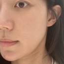 세이멍 | 모공축소 레이저 압구정 쿼드세이 + 쥬베룩 효과 있을까? 통증, 비용, 다운타임 후기