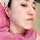 서면리프팅 후 오랩스 PHC 라인 기초화장품으로 관리