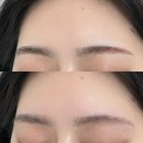 분당-157 | 분당 성남 야탑 잔흔제거 리니끄 브로우 눈썹문신제거 후기