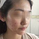 눈빛한의원 | 여드름자국 얼굴염증 내돈내산 한의원 관리 후기