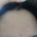 [여드름,좁쌀,등드름,가드름케어] 뷰드름 유튜버 인씨가 추천한 그 제품! 에센허브 티트리100오일...