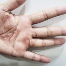 바른시선한의원 | 분당 습진 한의원 치료 기간 길게 느껴지나요
