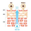 까치문구 라인 | 두피 지루성피부염 증상 및 관리법 후기