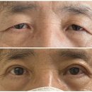 올림안과의원 | 안검하수 눈매교정 재수술? 두번 실패하기 싫은 분만 보세요