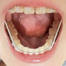 이든치과의원 | 9년차 치과위생사 재교정 시작_불광역교정/서울이든치과/내돈내산 재교정치과_5개월차