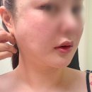 멍그린 | 얼굴 실리프팅 부작용 멍 없는 내돈내산 후기