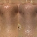 진주 | [2회차 후기]진주 소솜에스테틱 아기모공레이저 찐후기 💕