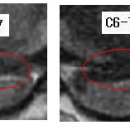 베라모드님의 경추디스크 C5-6, C6-7번의 MRi 사진 판독입니다. (2011년) [4급 판정] 이미지