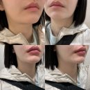 인간+자연 | 센텀 피부과 입술 얇은 인간의 자연스러운 입술필러 후기 내돈내산👄 (+입술 비대칭개선)
