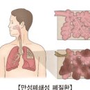 만성 폐쇄성 폐 원인 제 이미지