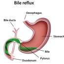 Re:Re: 메이요 클리닉 &#39;담즙 역류&#39;에 대하여 이미지