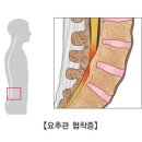 척추(요추)관 협착증(Lumbar spinal stenosis) 이미지
