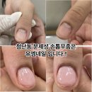 첨단동 문제성 손톱무좀, 결혼 전 꼭 회복하고 싶었던 그녀의 선택 – 유엠네일 케어 이야기
