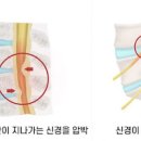 등이 아픈이유 등에 담이 생기는 원인과 증상 담 푸는법까지 이미지