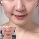 600 | 일산피부과 볼뉴머600샷 후기 볼뉴머 효과 통증 다운타임 전후비교