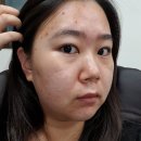 생피부관리실 | 동래구 피부관리 림에스테틱에서 효과 좋은 원데이필 후기