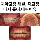 치아교정 재발 재교정. 교정 끝났는데 왜 또 틀어지나요? 송파 잠실 치아교정