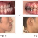 주걱턱 수술 - 주걱턱 교정으로 힘든 주걱턱의 수술교정 이미지