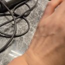 버팀병원 | 수원 손목터널증후군 어깨 수술 버팀병원 후기