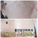 울산삼산피부과 제오민 스킨보톡스 솔직 후기 (전후, 통증, 장점 총정리)