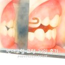 공주현대병원 | 초등 반대교합 교정 39일 후기｜페이스마스크 교정 효과, 얼굴형 변화까지