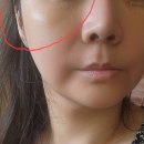 홍대 피부과 팔자주름 실리프팅 내돈내산 후기 원더트리플