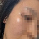 키키디디 | 뷰앤디디써마 1년사용후기 뷰앤디디써마팔자주름 내돈내산 뷰티디바이스