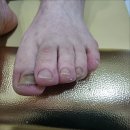 수블리네일 | 부산 사직동 내성발톱 무좀발톱 복합 문제 수블리네일에서 관리 받은 후기