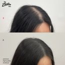 레이븐스칼프 | 수성구두피문신 / 20대 여성 탈모 커버 후기 / 레이븐스칼프