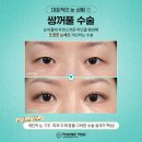 첫눈성형 후기 좋은 땡큐에서 만드는 예쁜 눈매💚