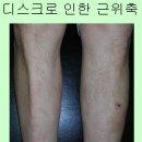 2) 허리디스크의 5가지 예후 판단방법 이미지