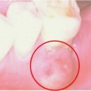 치주농양 (Periodontal abscess 이미지