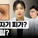 결막출혈. 잦은 눈충혈. 빨리 사라지게 하는 방법. 꼭 &#39;이렇게&#39; 해 보세요. 이미지