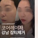 (주)MCL | 코어레이저 받으러 강남 잡티제거 피부과 다녀온 솔직 후기