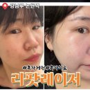 논현모두약국 | 강남 논현피부과에서 추천한 리팟레이저 내돈내산[흑자치료 효과]